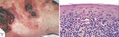 Mycosis Fungiodes