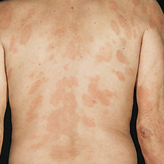 Mycosis fungoides (Cutaneous T Cell Lymphoma)