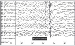 Myoclonic Astatic Epilepsy EEG (Doose s/d)