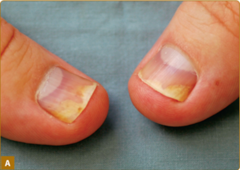 Nail psoriasis.   Panel A demonstrates distal onycholysis and oil drop spotting.   Fitzpatrick's Figure 18-15