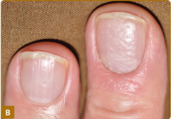 Nail psoriasis.   Panel B demonstrates nail pitting.   Fitzpatrick's Figure 18-15