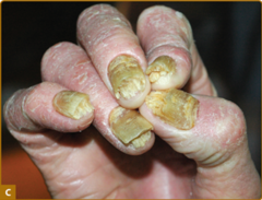 Nail psoriasis.   Panel C demonstrates subungual hyperkeratosis.   Fitzpatrick's Figure 18-15