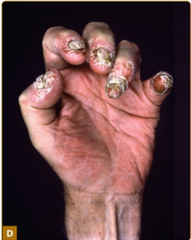 Nail psoriasis.   Panel D demonstrates onychodystrophy and loss of nails in a patient with psoriatic arthritis.   Fitzpatrick's Figure 18-15