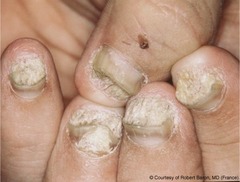 Nail psoriasis