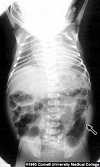 Necrotizing enterocolitis - What do you see on X-ray? pneumocystis intestinal (air in bowel wall) - Treatment? NPO, TPN (if nec), antibiotics and resection of necrotic bowel  - Risk factors? Premature gut, introduction of feeds, formula.
