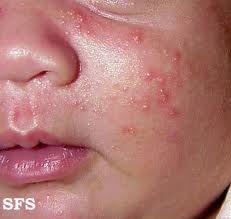 Neonatal acne