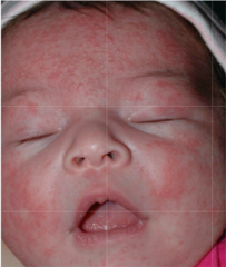 Neonatal Cephalic Pustulosis (neonatal acne) malassezia follicular pustules with PMNs