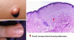 Neurofibroma