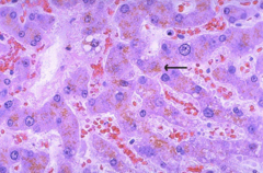 Neuronal ceroid lipofuscinosis (NCL)