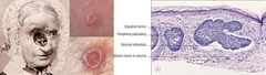 Nodular (Classic) Basal Cell Carcinoma