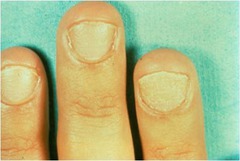 Nonspecific nail pitting, here associated with Alopecia Areata