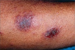 Nummular Dermatitis
