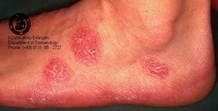 Nummular Eczema  Coin-shaped chronic plaques consisting of grouped papules on an erythematous base  (Marlin D&E Lecture PP41;43)