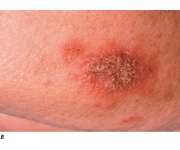 Nummular Eczema  Exact cause unknown  (Marlin D&E Lecture PP41;46)