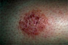 Nummular Eczema  (Marlin D&E Lecture PP42;47)