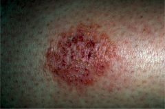 Nummular Eczema  Skin hydration Class I and II topical steroids  Antibiotics if S. Aureus present  Cold tar ointment in severe cases  (Marlin D&E Lecture PP42;47)