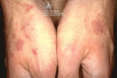 Nummular Eczema  Watch for secondary bacterial infection  (Marlin D&E Lecture PP41;45)