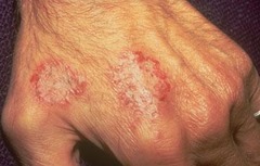 Nummular Eczema  Worse in fall and winter  (Marlin D&E Lecture PP41;45)