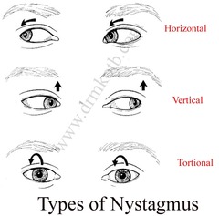 Nystagmus