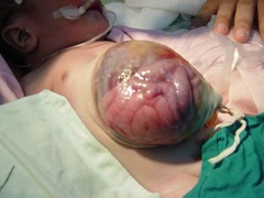 Omphalocele Assoc w/ Edwards & Patau Trisomies, Beckwith Wiedemann Syndrome = big baby w/ big tongue, ?glc, ear pits
