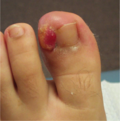 Onychocryptosis (Ingrown nail)