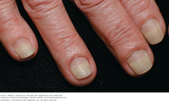 Onycholysis   A 60-year-old female with distal onycholysis of fingernails, mild chronic paronychia, and loss of cuticle. Psoriasis is the likely underlying problem.  Fitzpatrick Figure 32-3