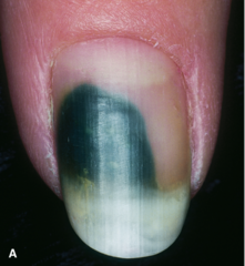 Onycholysis with Pseudomonas colonization   (A) Psoriasis has resulted in distal onycholysis of the thumbnail.   Fitzpatrick Figure 32-4