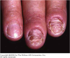 Onychomycosis