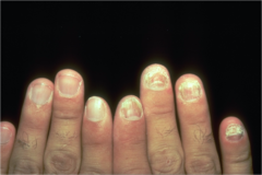 Onychomycosis (Most commonly caused by T. rubrum, T. mentagrophytes; physical exam shows yellow, thickening and dystrophy, subungual debris, superficial white changes.)