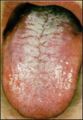 Oral Candidiasis symptoms