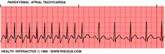 Paroxysmal atrial tachycardia (PAT, PSVT)