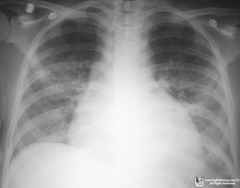 PCP Dx: Bronchoscopy w/ BAL to visualize bug