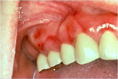 Pemphigus Vulgaris (90% will develop oral ulcers, and 50% present with oral ulcers, may involve buccal mucosa or tongue.)