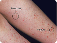 Petechiae and papura (secondary lesion)