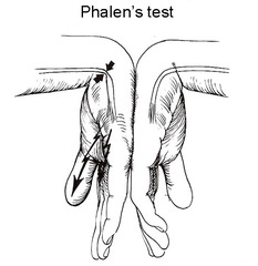 Phalen sign