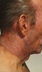 Photosensitive eczema