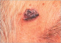 Pigmented Basal Cell Carcinoma