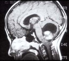 Pilocytic astrocytoma of cerebellum. Resect:~90% survive