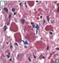 Pilocytic [Low-Grade] Astrocytoma