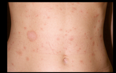 pityriasis rosea (note large herald patch)
