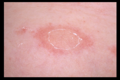 pityriasis rosea with crinkled appearance