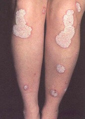 Plaque psoriasis