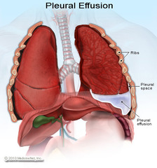 Pleural Effusion  - What is it and when can it occur?