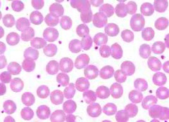 PLT:Platelet (Thrombocyte)