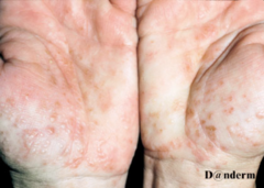 Pompholyx eczema - hands and feet