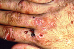 Porphyria cutanea tarda  Always think of with Hep C, isolated rash on hands  Urine uroporprin levels just confirm it  Can be scaly, blistering, vesicles
