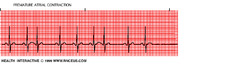 Premature Atrial Contractions (PAC)