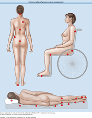 Pressure ulcers  Common sites of pressure ulcer development.   Figure 100-2