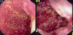 Pseudomembranous Colitis epidemiology