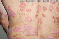 PSORIASIS: its always bilateral, silvery scalses